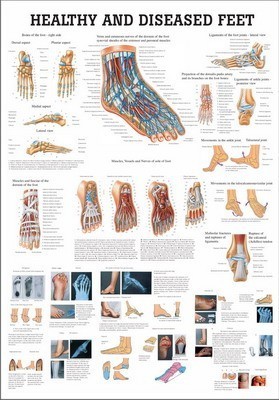 Anatomie Poster gezonde en zieke Voet 70 x 100cm. | | Spor